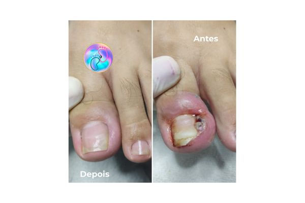 Foto de antes e depois do tratamento 14